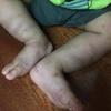 Bé trai khoảng 1 tuổi nghi bị bạo hành. (Nguồn: Bệnh viện Nhi Trung ương)