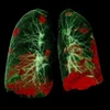 Chụp CT phổi của bệnh nhân cho thấy tổn thương COVID-19 màu đỏ. (Nguồn: healthcare-in-europe.com)