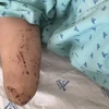 Một bệnh nhân bị đứt lìa bàn tay phải do pháo tự chế nổ. (Ảnh: TTXVN phát)