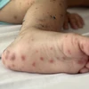 Nốt hồng ban ở chân của một trẻ mắc bệnh tay chân miệng. (Ảnh: Đinh Hằng/TTXVN)