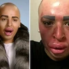 Mặt biến dạng khủng khiếp vì phẫu thuật cho giống Kim Kardashian