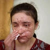 Ký ức đau thương của cô gái 18 tuổi làm nô lệ tình dục cho IS