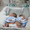 Cặp song sinh dính liền vùng mông được y bác sỹ chăm sóc tích cực tại phòng cách ly trẻ sơ sinh non tháng của bệnh viện Nhi Đồng 2 Thành phố Hồ Chí Minh. (Ảnh: Phương Vy/TTXVN)