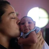 Một trẻ sơ sinh bị mắc căn bệnh đầu nhỏ do mẹ bị nhiễm virus Zika khi mang thai tại Rio de Janeiro ngày 4/2. (Nguồn: THX/TTXVN)