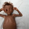 Một cậu bé bị suy dinh dưỡng nằm trên một chiếc giường bên ngoài túp lều của gia đình ở quận al-Tuhaita, Yemen. (Nguồn: Reuters)