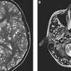 Kết quả chụp MRI cho thấy chàng trai có nhiều nang trong vỏ não (hình bên trái là các chấm trắng). Các tổn thương cũng được tìm thấy trong thân não và tiểu não của anh ta (nhìn bên phải). (Nguồn: dailymail.co.uk) 