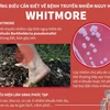 [Infographics] Những điều cần biết về căn bệnh nguy hiểm Whitmore