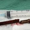 Thanh tre đâm vào cổ nam bệnh nhân được các bác sỹ Bệnh viện đa khoa Hùng Vương phẫu thuật lấy ra. (Ảnh: Trung Kiên/TTXVN) 