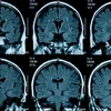 ​Sức khỏe tâm thần giảm sút đi đôi với những thay đổi về cấu tạo vật lý của não bộ ở thiếu niên. (Nguồn: Getty Images)