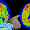 Hình ảnh não của bệnh nhân Alzheimer khi chụp PET. (Nguồn: Reuters)