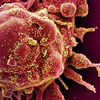 Hình ảnh quét qua kính hiển vi điện tử cho thấy một tế bào (màu đỏ) bị virus SARS-COV-2 (màu vàng) xâm nhập, lấy từ mẫu bệnh phẩm của bệnh nhân COVID-19. (Ảnh: AFP/ TTXVN)