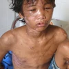 Cháu Nguyễn Hào Anh bị đa chấn thương do bị hành hạ, đánh đập dã man. (Ảnh: Điệp Hồng/TTXVN)
