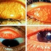 Đau mắt hột - một trong những căn bệnh bị thế giới lãng quên. (Ảnh: Internet).