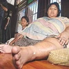 Nurhaniza Ahmad với chiếc chân trái to quá khổ. (Ảnh: Thestar.com).
