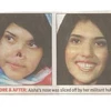 Aisha trước và sau phẫu thuật chụp từ báo The Times of India.