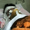 Một nạn nhân sống sót sau vụ tai nạn máy bay được điều trị tại bệnh viện. (Ảnh: AFP/TTXVN)
