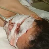 Một nạn nhân bị thương vùng mặt do nổ bình khí hydro đang được cấp cứu tại bệnh viện. (Nguồn: Vietnamnet)