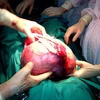 Các y, bác sỹ đang thực hiện ca phẫu thuật cắt bỏ khối u nặng 4,8kg. (Nguồn: baohagiang.vn)