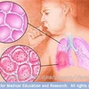 Khí thải của động cơ diezel là nguyên nhân gây ung thư phổi. (Nguồn: Internet)