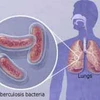 Vi khuẩn lao trong cơ thể người bệnh. Ảnh minh họa. (Nguồn: sggp.org.vn)