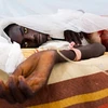Một bệnh nhân bị sốt vàng da. (Nguồn: theniles.org) 