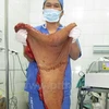 Khối u của bệnh nhân được các bác sỹ tách ra sau khi phẫu thuật. (Ảnh: PV/Vietnam+)