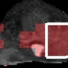 Một hình ảnh MRI của tuyến tiền liệt, với vùng màu đỏ thể hiện sự hiện diện của tế bào ung thư tuyến tiền liệt. (Nguồn: Internet)