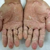 Bàn tay người bị "bệnh lạ". (Nguồn: Vietbao.vn)
