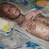 Bệnh nhân Điền bị bệnh dẫn đến bong tróc da. (Nguồn: Vnexpress)