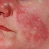 Bệnh lupus ban đỏ có liên quan đến rối loạn gen. (Nguồn: Internet)