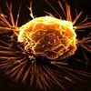 Tế bào ung thư vú. (Nguồn: news-medical)