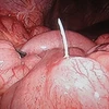 Một ca bệnh nhân bị tăm tre đâm thủng ruột. Ảnh minh họa. (Nguồn: Google Images)