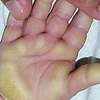 Hội chứng viêm da dày sừng bàn tay bàn chân. 