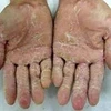 Dấu hiệu của bệnh viêm da bàn tay bàn chân. (Nguồn: dalieu.vn)