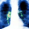 Hình ảnh viêm phổi cấp tính do Legionella.(Nguồn: suckhoedoisong.vn).
