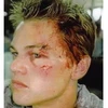 Gương mặt của Leo sau khi bị tấn công. (Nguồn: Internet)