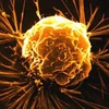 Tế bào ung thư vú. (Nguồn: Internet)