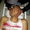 Một người biểu tình bị thương trong cuộc bạo loạn ở thành phố Tala, Tunisia. (Ảnh: AFP/TTXVN)
