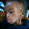 Trẻ em Somalia bị suy dinh dưỡng nặng điều trị tại bệnh viện ở Mogadishu ngày 2/8. (Ảnh: AFP/TTXVN)