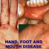 Các biểu hiện của bệnh tay-chân-miệng. (Nguồn: Internet)