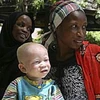 Một em nhỏ bị bạch tạng ở Tanzania (Nguồn: The Sun)
