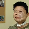 Cậu bé Phạm Hoàng Sơn sau nhiều ca phẫu thuật.
