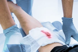 Các nhà nghiên cứu từ Australia, Nhật Bản, Anh và Mỹ đã sử dụng huyết tương để phát triển phương pháp điều trị hiệu quả hơn cho các vết thương lâu lành. (Nguồn: Netcare)