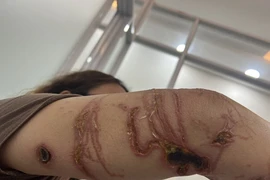 Những vết thương ngoài da của một bệnh nhân bị sứa quất. (Ảnh: Báo Tin tức/TTXVN)