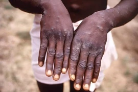 Bệnh nhân mắc đậu mùa khỉ ở Cộng hòa Dân chủ Congo. (Nguồn: Getty Images/TTXVN)