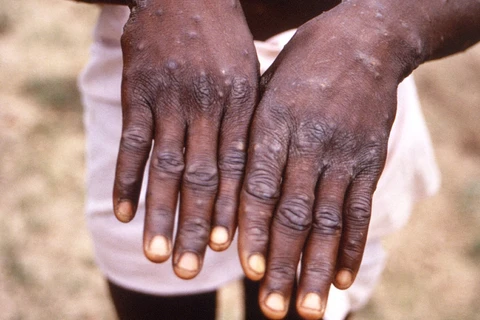 Các vết phát ban của một bệnh nhân mắc đậu mùa khỉ. (Nguồn: Reuters)