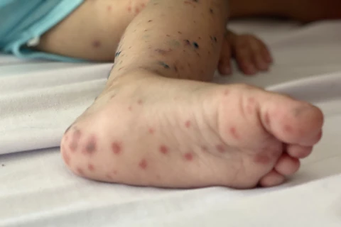 Nốt hồng ban ở chân của một trẻ mắc bệnh tay chân miệng. (Ảnh: Đinh Hằng/TTXVN)