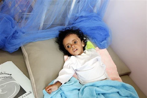 Trẻ em bị suy dinh dưỡng điều trị tại bệnh viện ở Sanaa, Yemen. (Ảnh: THX/TTXVN)