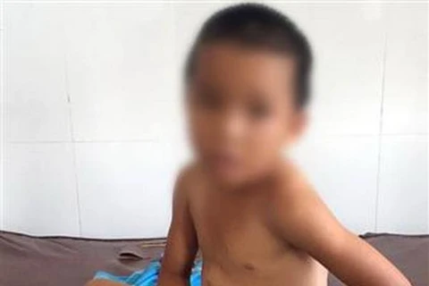 Một cháu bé bị bạo hành tại Sóc Trăng. (Ảnh: TTXVN phát)