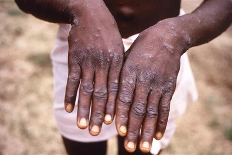 Các ban đỏ nổi trên tay một bệnh nhân mắc bệnh đậu mùa khỉ. (Nguồn: AFP/TTXVN)